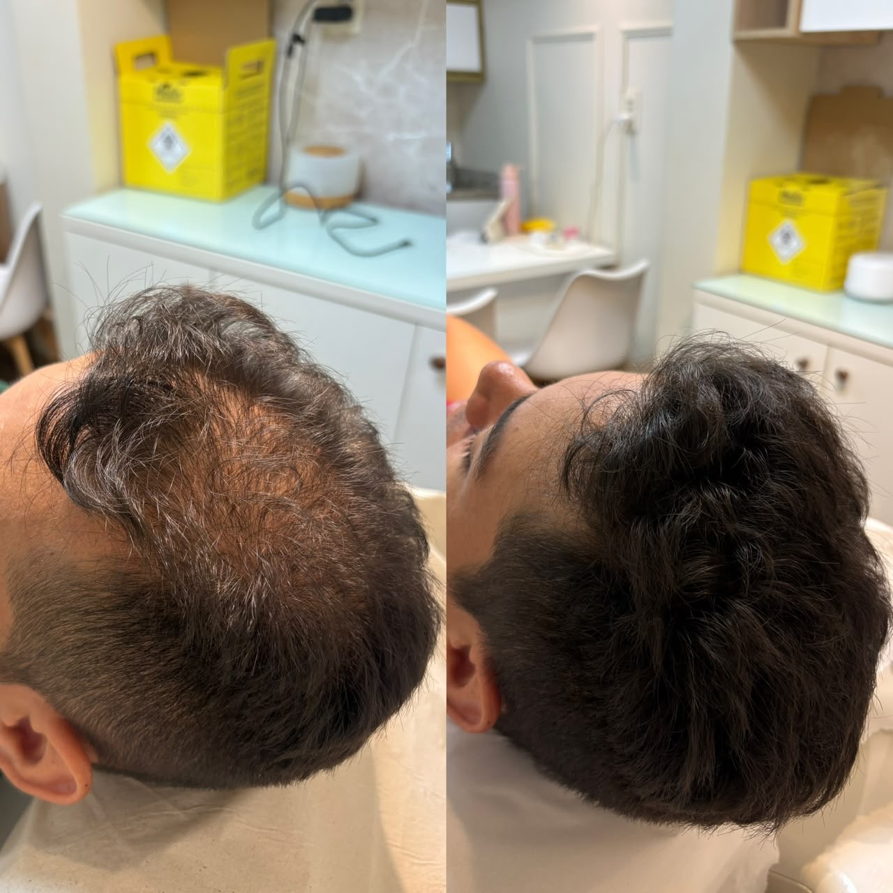 Comparativo antes e depois de evolução capilar do caso 01